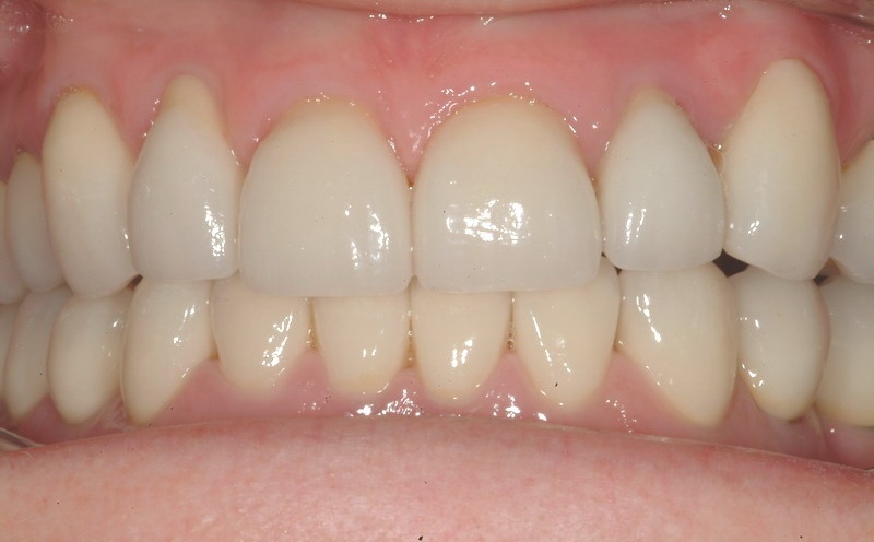Les dents apres les soins dentaires