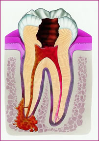 Dévitalisation de la dent