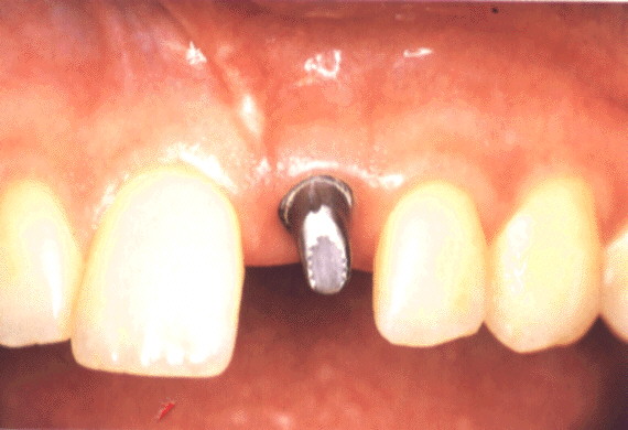 Apres la pose d'un implant dentaire
