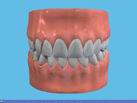 Blanchiment des dents ambulatoire 