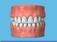 Dentier partiel amovible