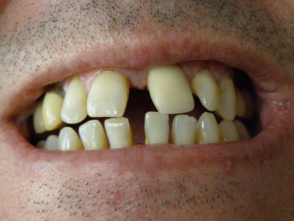 Les dents d'un client avant le traitement