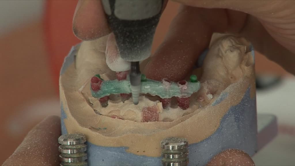 La préparation d'un dentier mobile